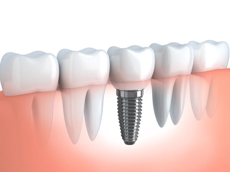 Dental Implants Seneca, SC 